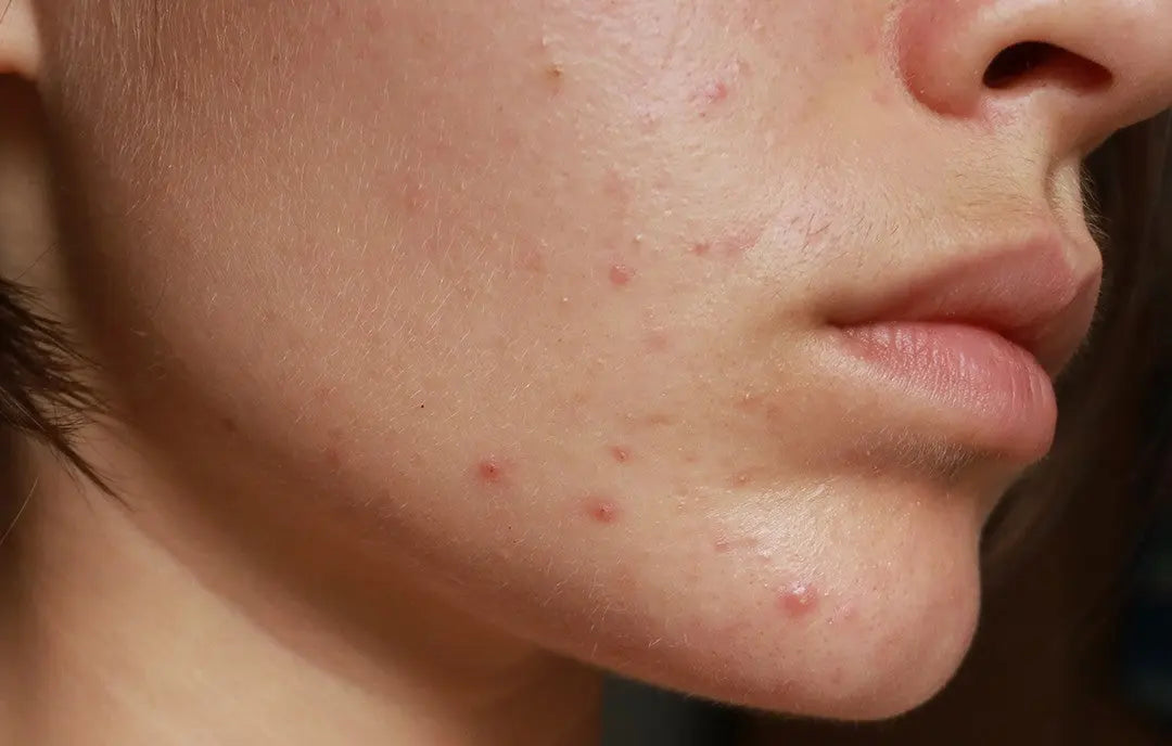 acne. glycolic acid. salicylic acid