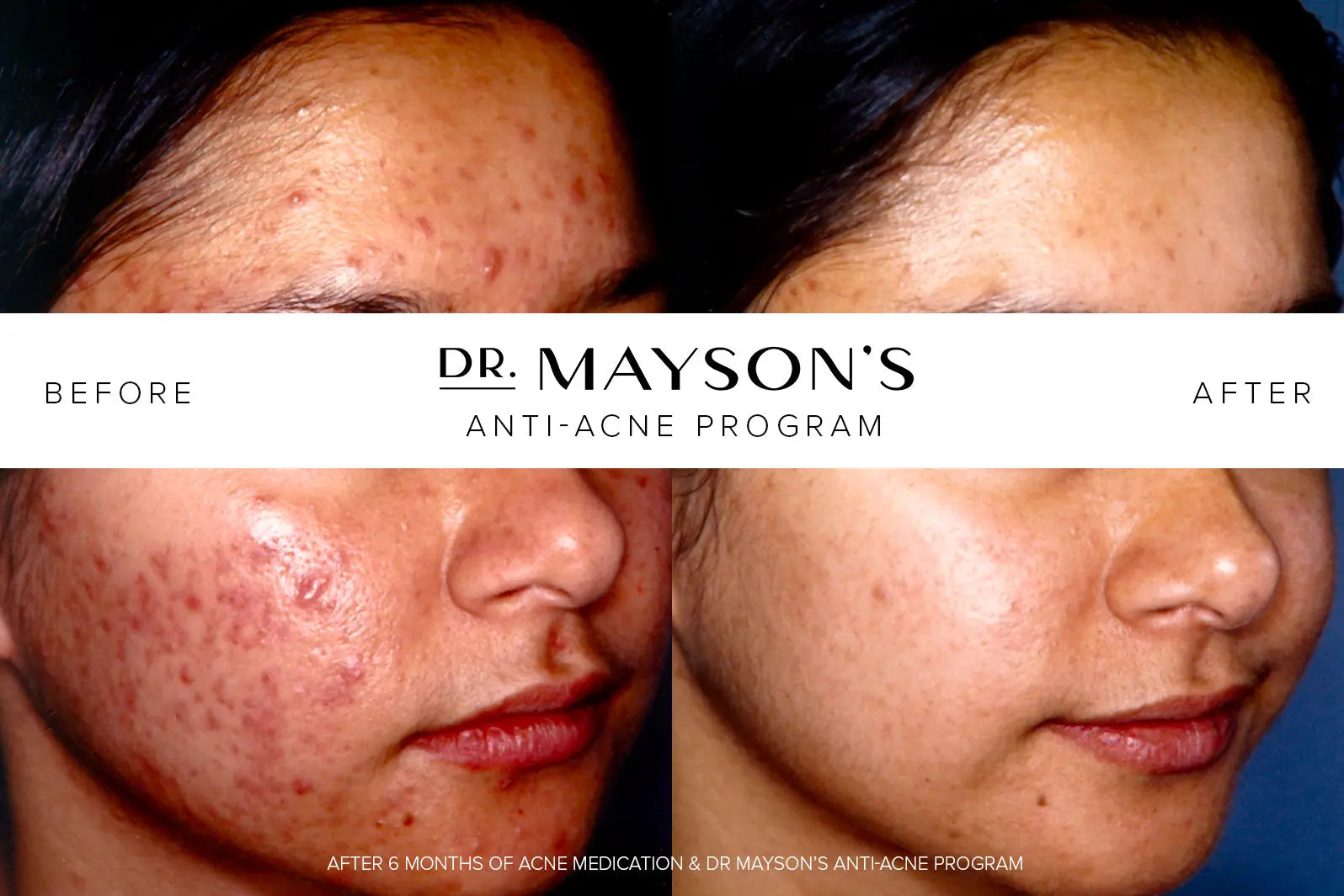 acne. acne treatment. roaccutane. dr mayson's anti-acne program