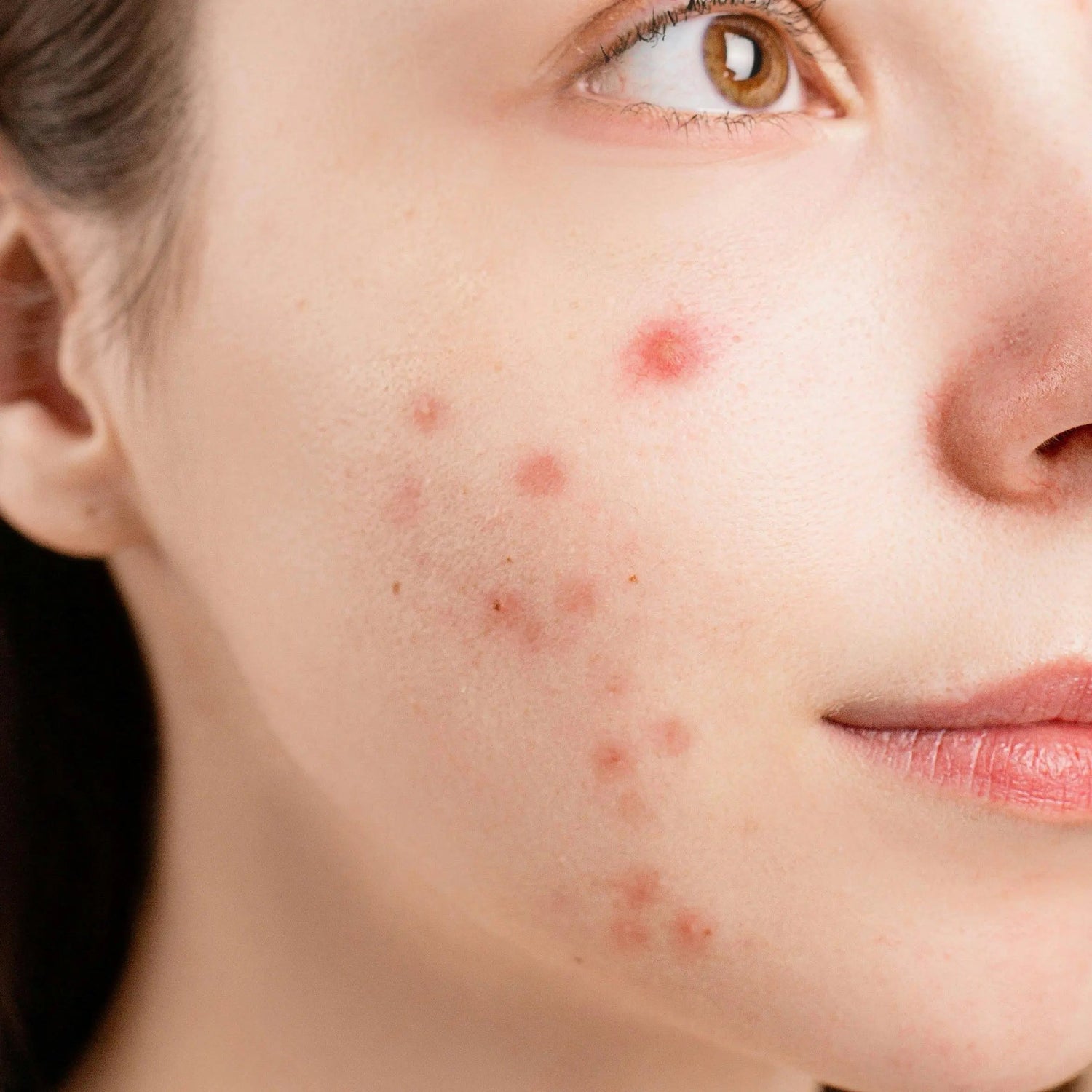 causes of acne. acne development. acne-prone skin