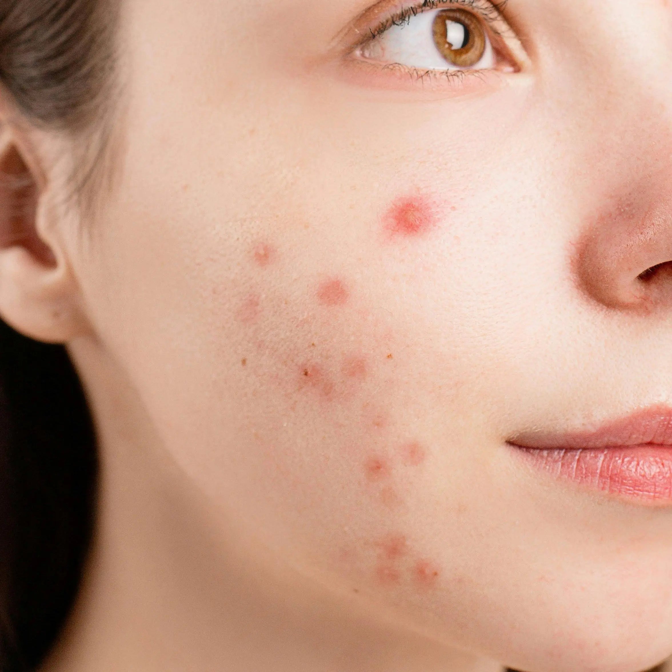 causes of acne. acne development. acne-prone skin