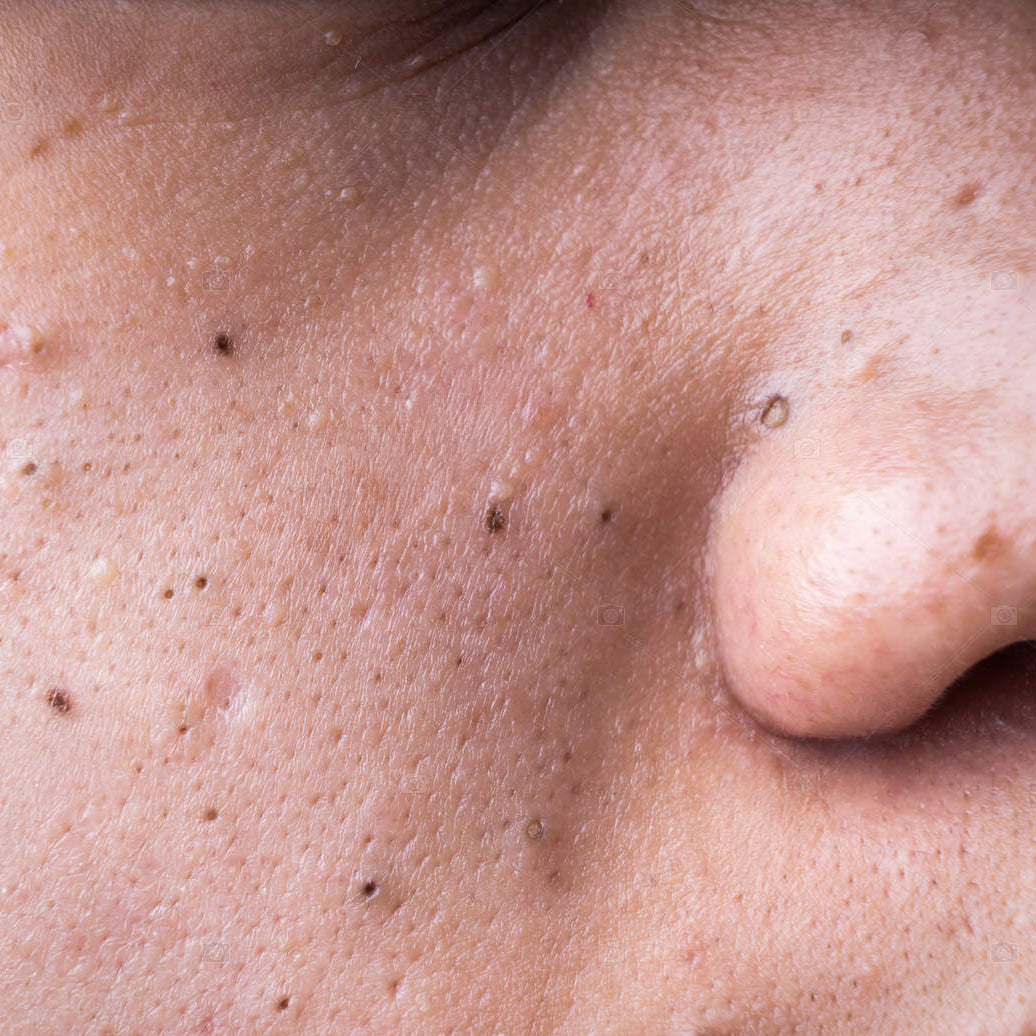 Blackhead removal