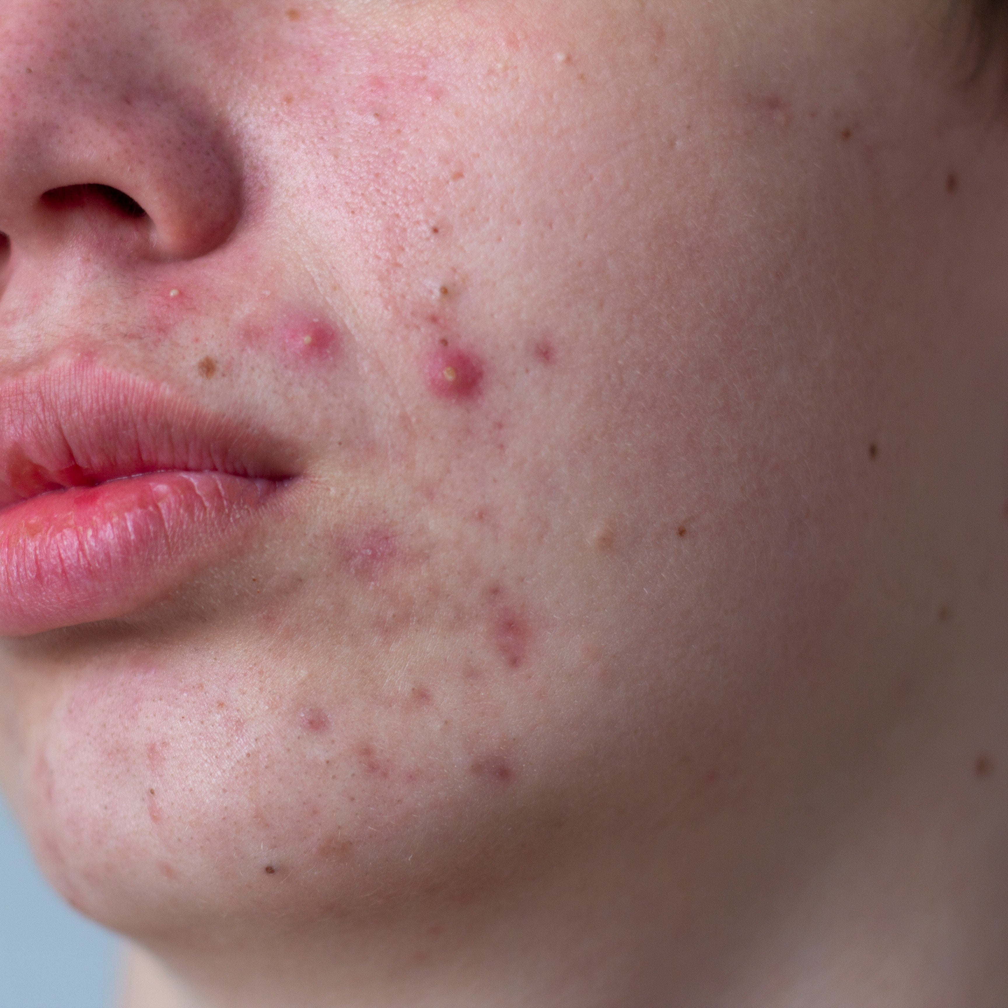 Hormonal Acne vs Adult Acne