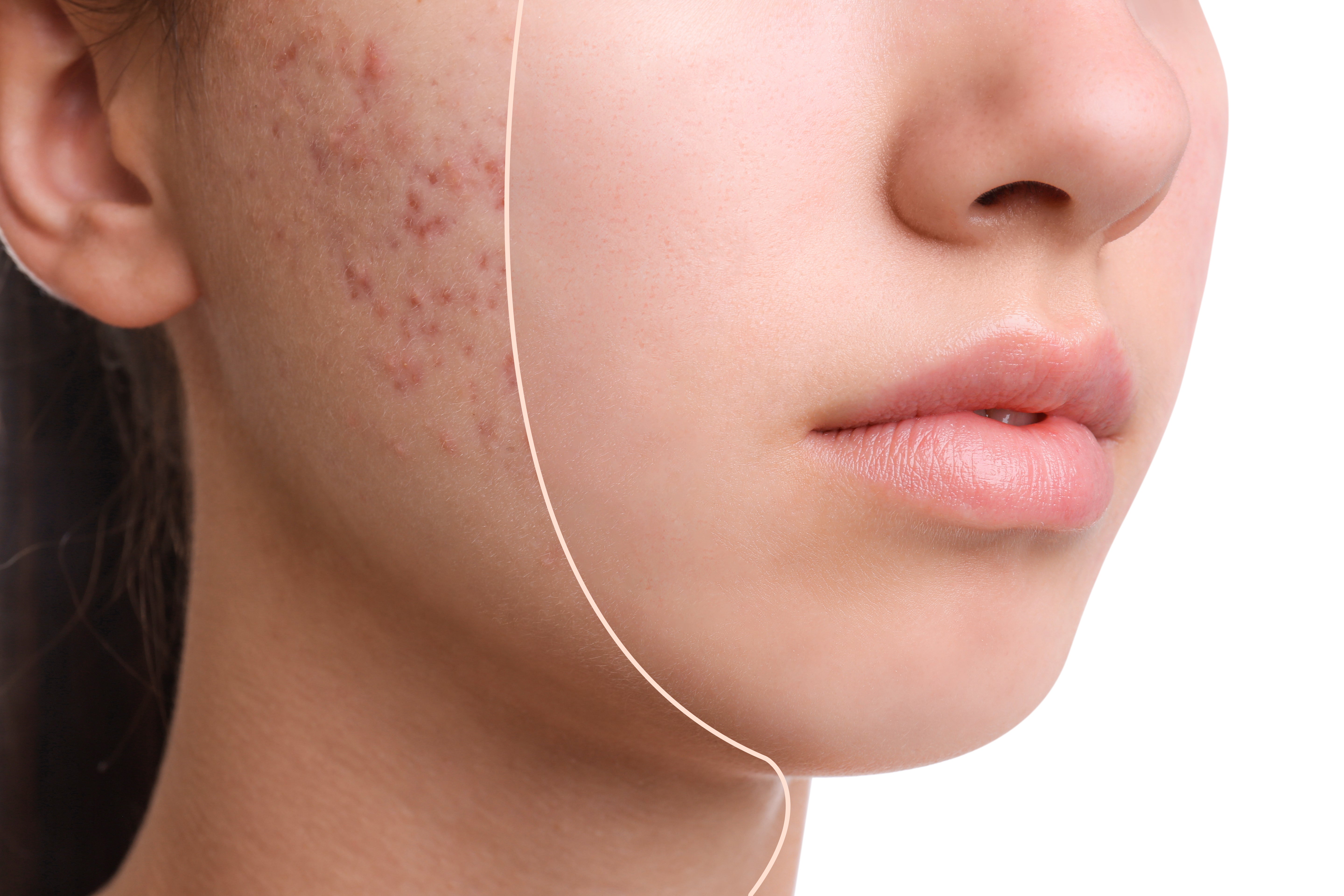 How to get rid of acne