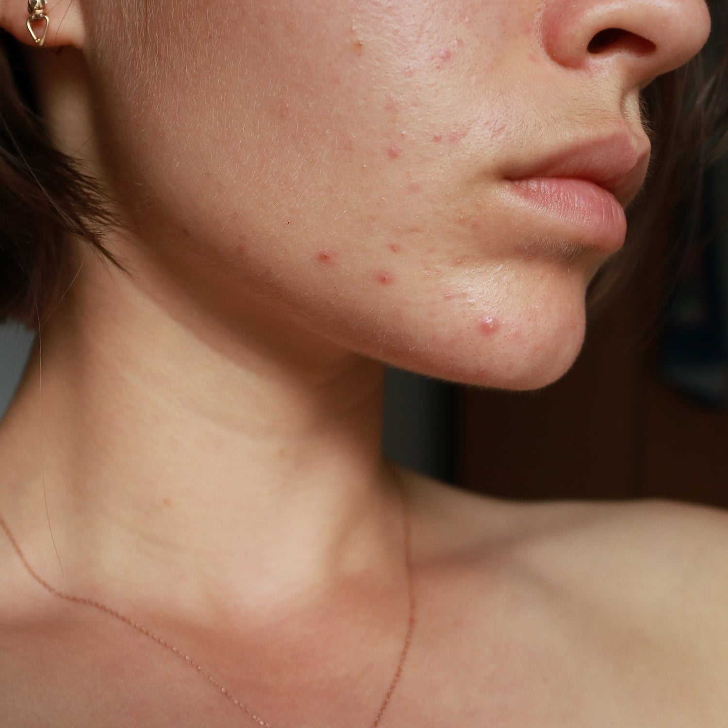 Anti-Acne Program