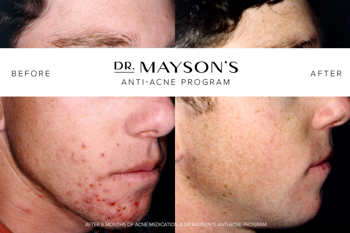 Intermediate Acne Program Anti-Acne Program | Targets the Root Causes of Acne While You Sleep ...